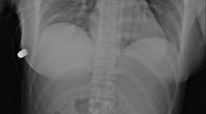 bala implante mamario