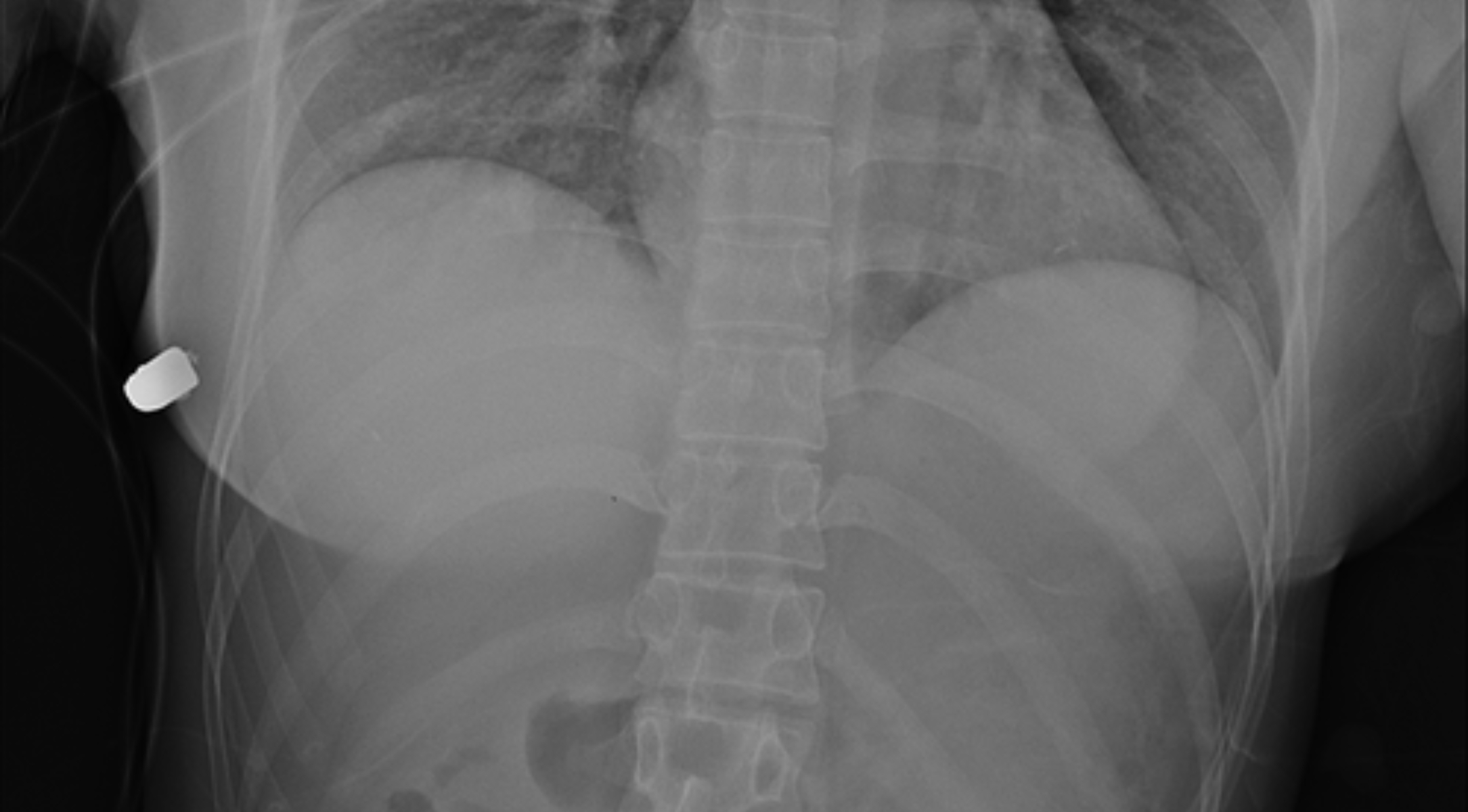 bala implante mamario