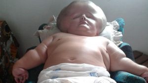 La historia de una “bebé gigante” que sufre de hidrocefalia; mide un metro y pesa 69 kilos