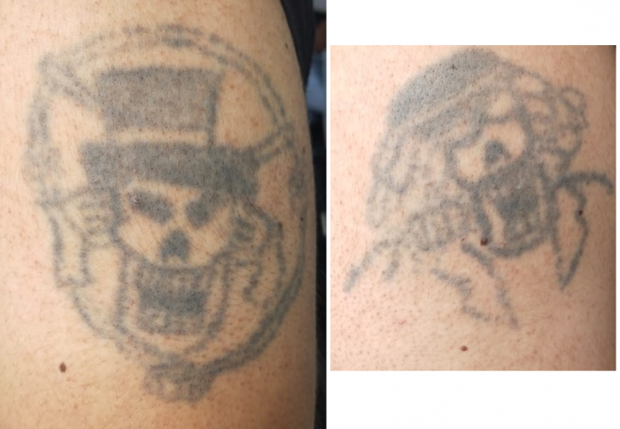 Tenía 14 años, cuando nuestro oyente se hizo este tatuaje a bordo de un bus que iba camino al concierto de los Guns N' Roses en 1992.