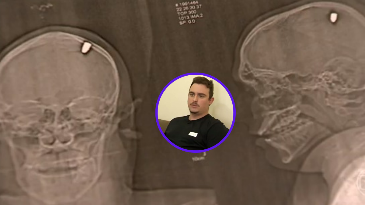 Imagenes de la incrustación de una bala en la cabeza de Mateus Facio. (Foto tomada como captura de pantalla del reporte del portal 'Jornal Nacional')