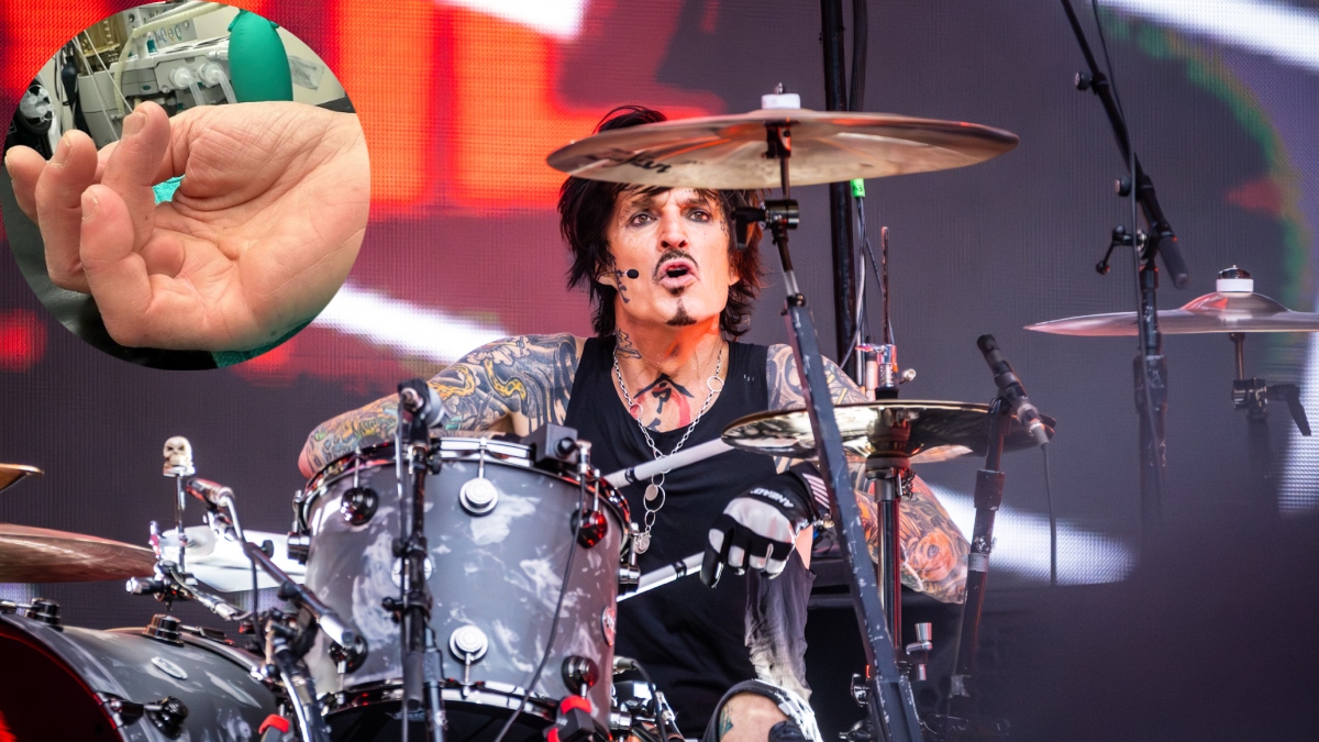 Tommy Lee, baterista de Mötley Crüe, se operó la mano y compartió escabrosas imágenes